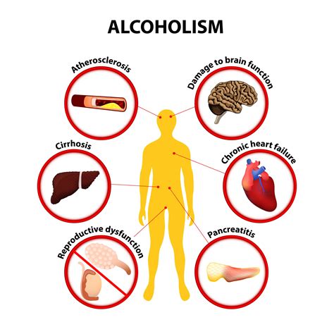 Alcohol consumption, alcohol use disorder and organ transplantation.